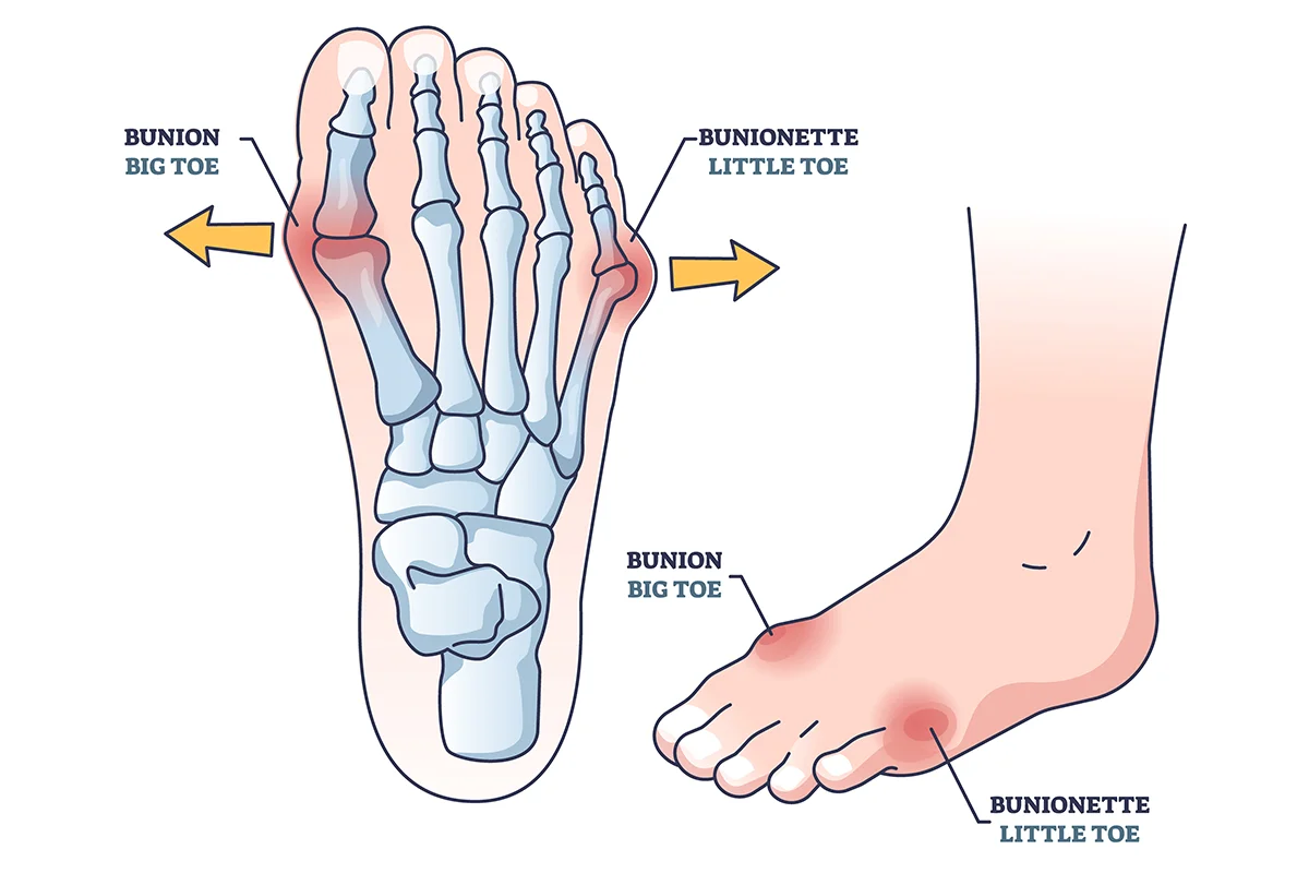 Bunion deformity condition